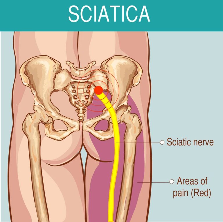 Can A Car Accident Cause Sciatica Nerve Pain?