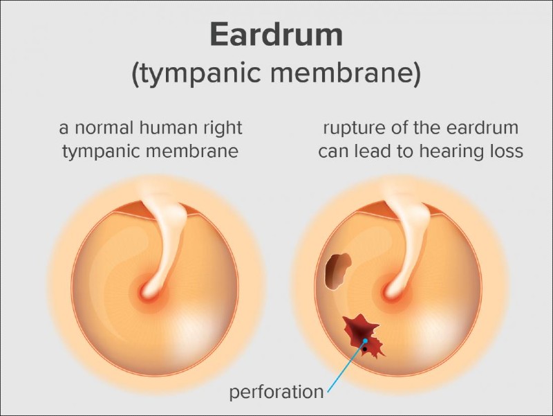 Ruptured eardrum