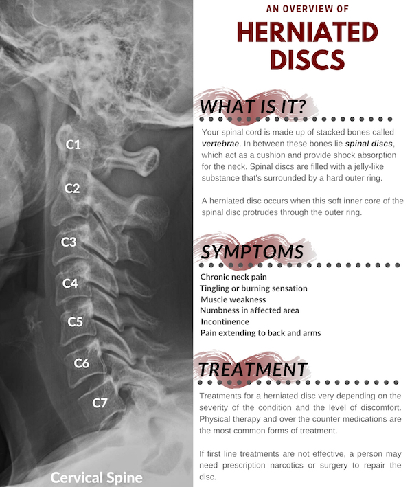 herniated disc what is it