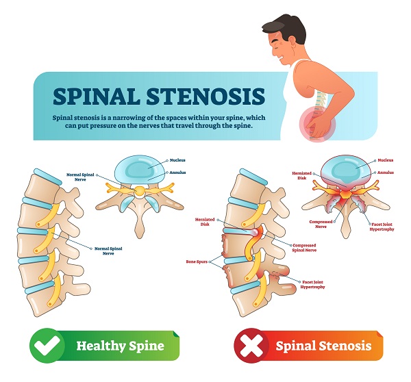 spinal stenosis injury