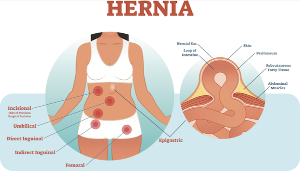 what is hernia