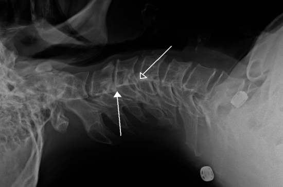 x ray of vertebrae in the neck affected by retrolisthesis br image credit james heilman md 2012 march 26 br